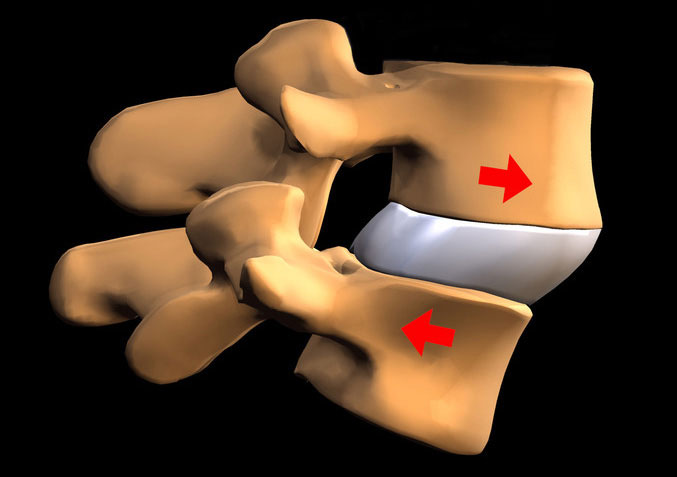 SPONDYLOLISTHÉSIE